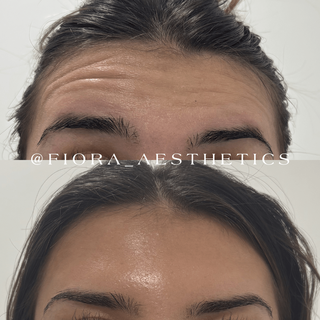 Close-up of a person's forehead and eyebrows before and after skincare treatment, showing improved skin texture and appearance.