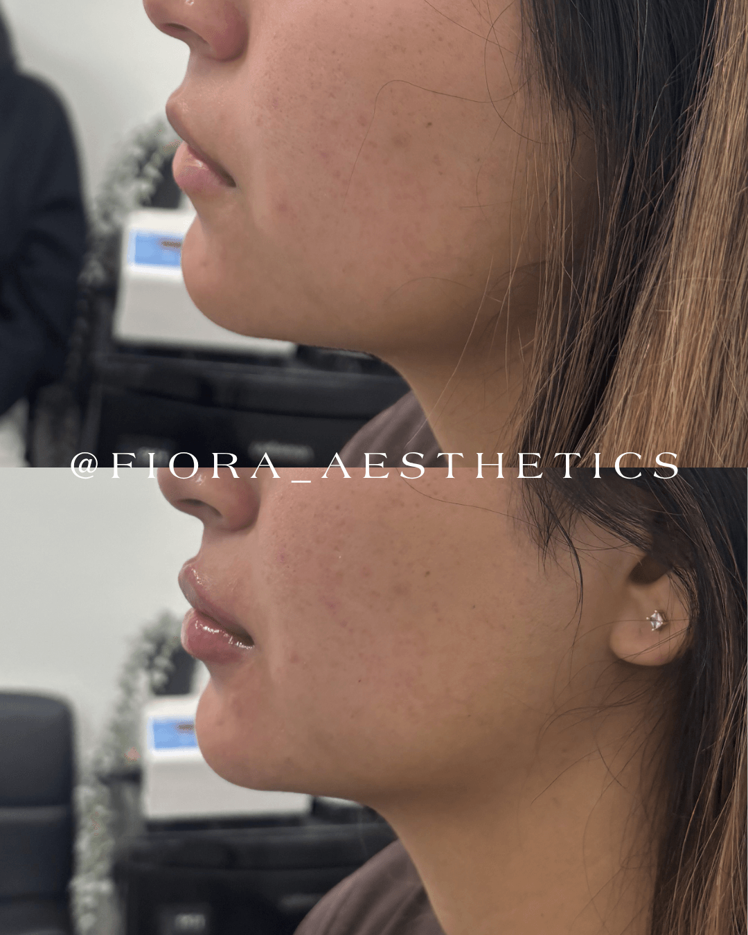 Side profile of a woman's face showing skin texture and a small earring, before and after skincare treatment.