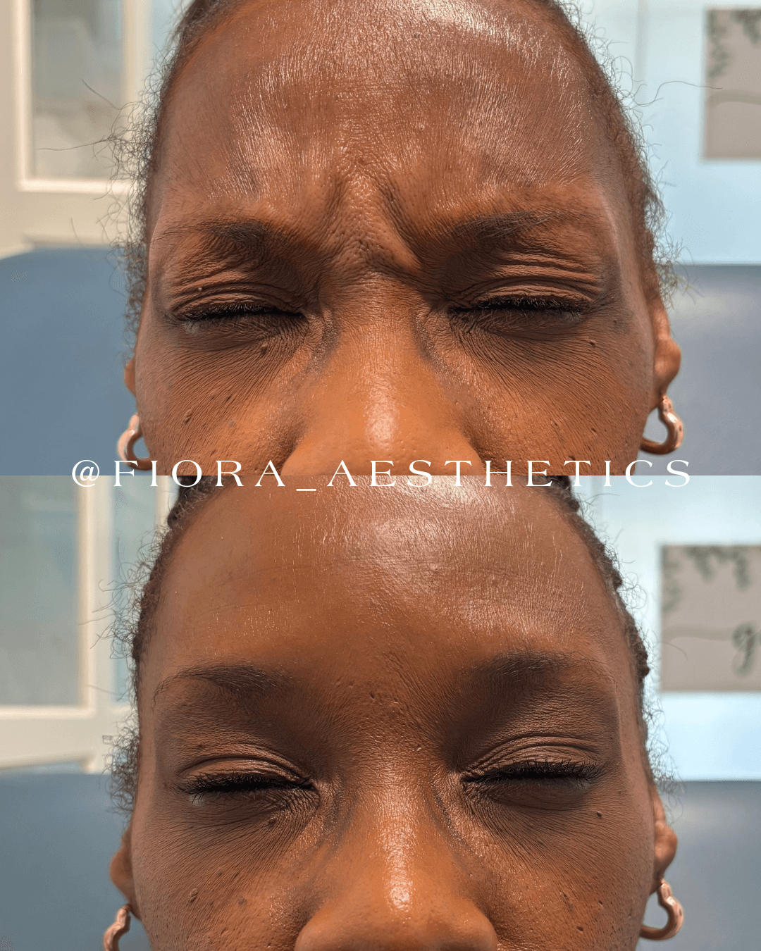 Close-up of a person's face with eyes closed, showing forehead and nose, before and after skincare treatment, indoors.