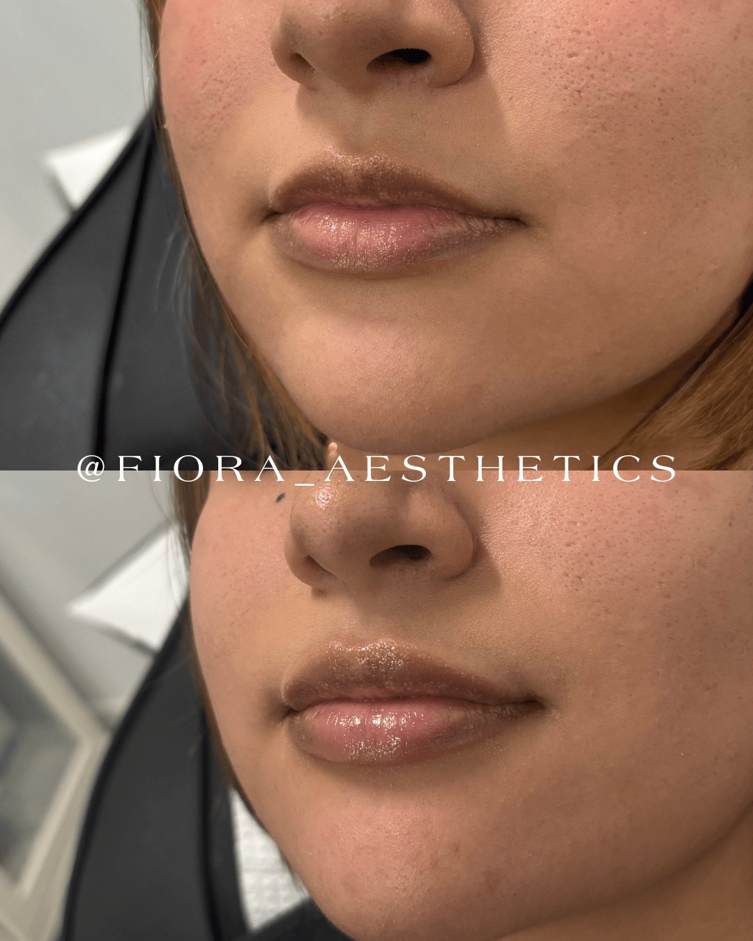 Close-up of a person's lips and lower face, showing before and after cosmetic treatment, with smooth skin and glossy lips.