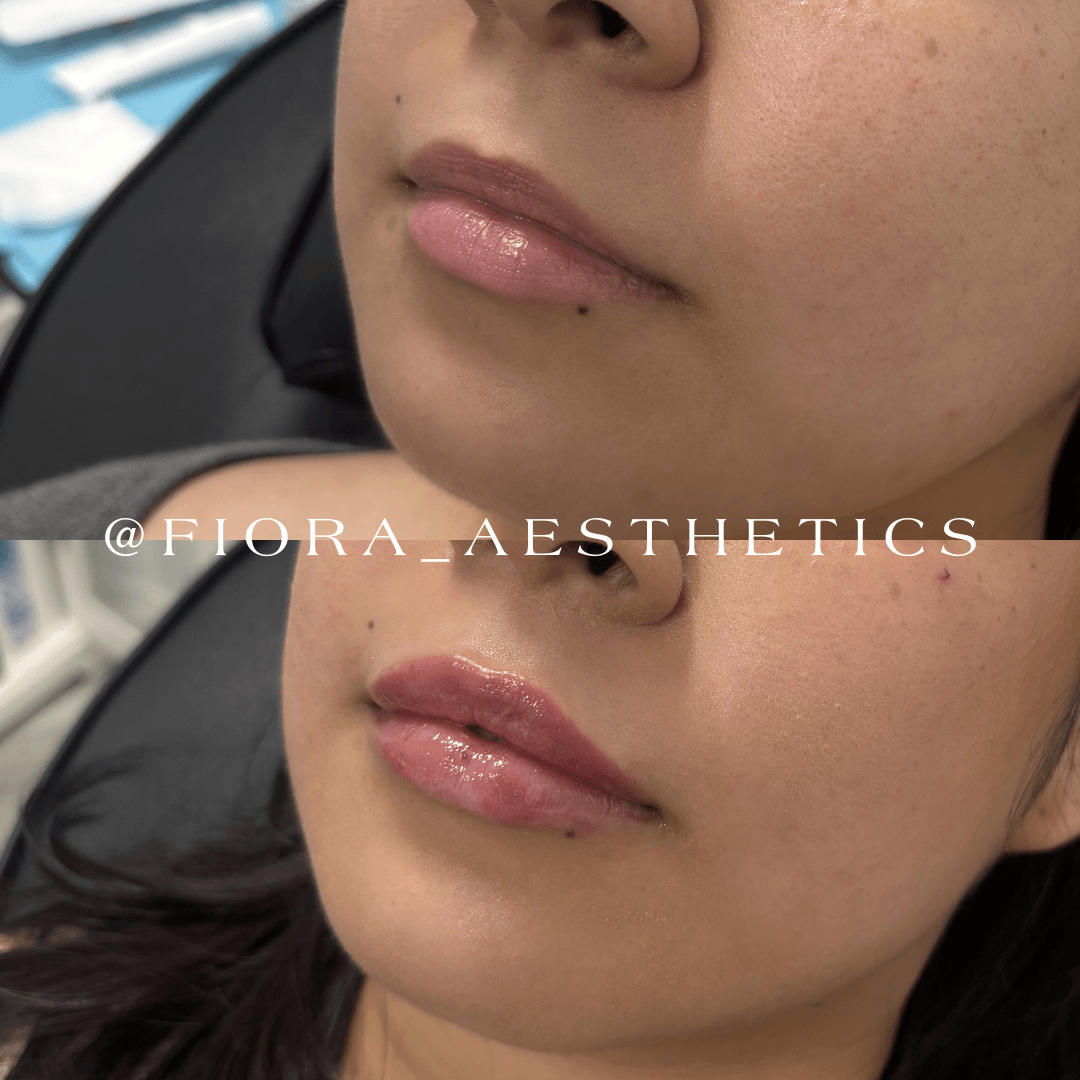 Close-up of a person's lips and lower face, showing before and after cosmetic treatment, with smooth skin and glossy lips.