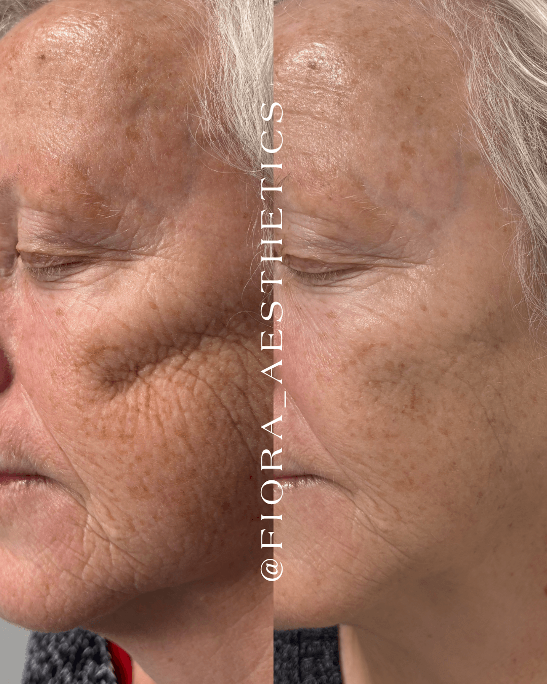 Side-by-side comparison of a person's face showing skin improvements, with visible reduction in age spots and wrinkles.