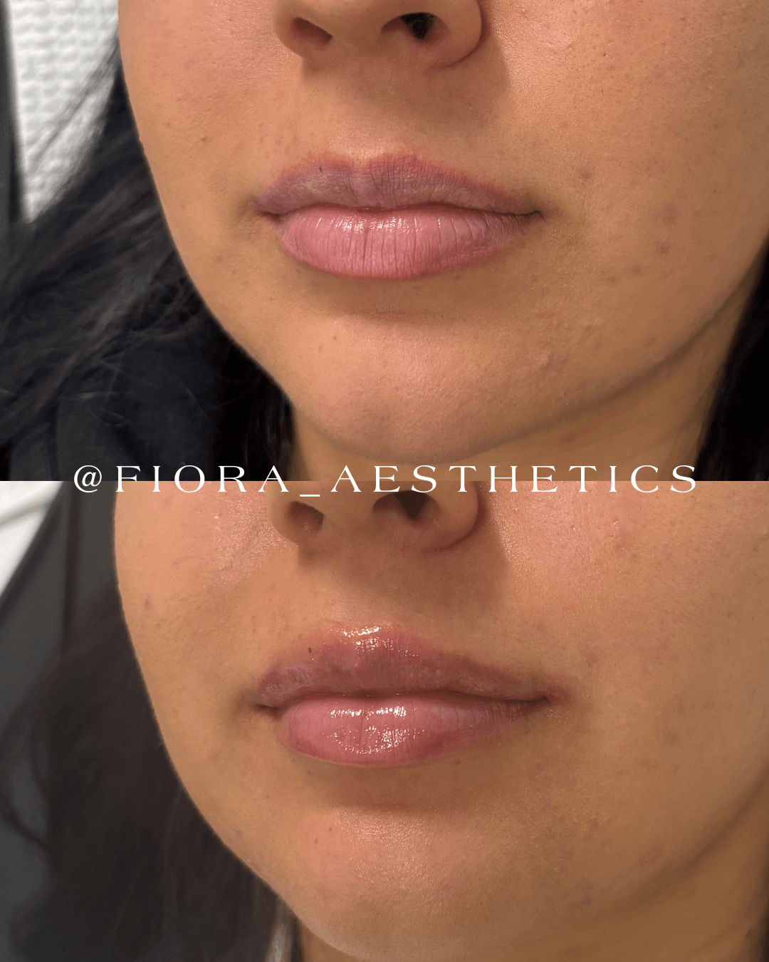 Close-up of a person's lips and lower face before and after cosmetic treatment, showing smoother, glossier lips post-treatment.