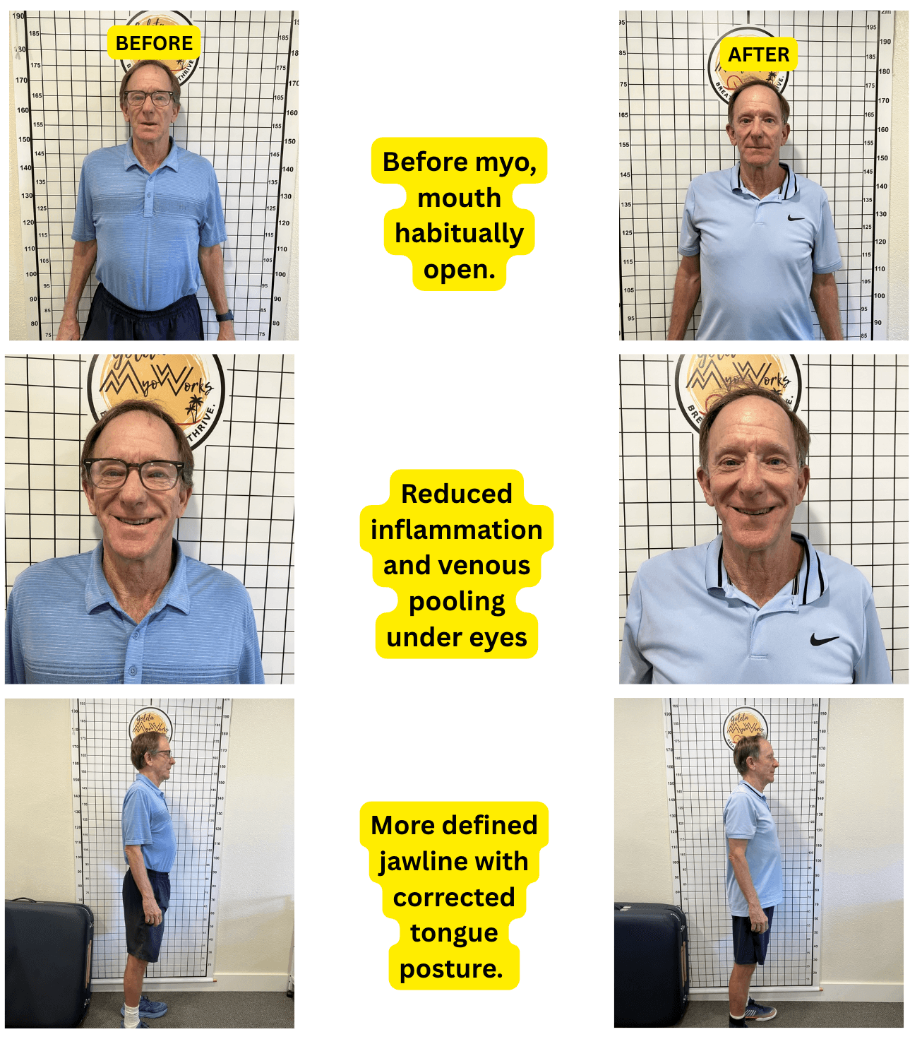 Comparison of before and after images showing improved facial and jaw features, side views, and posture after treatment.