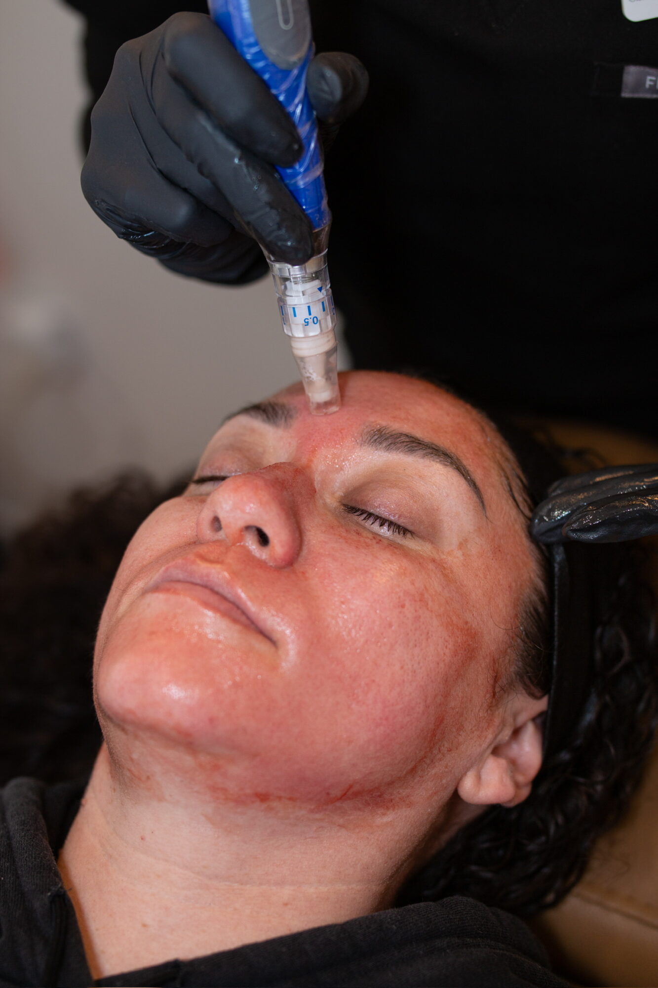 Person receiving a facial treatment with a device on their forehead, eyes closed, lying down, hand wearing a glove holding the device.