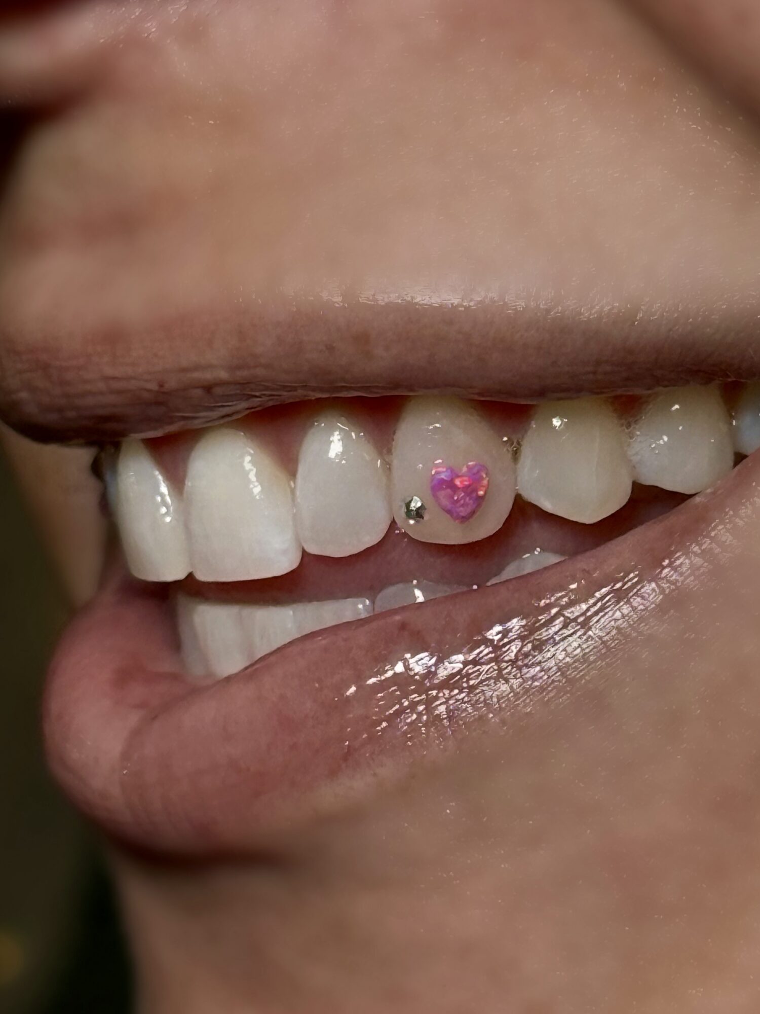 Close-up of a person's mouth showing teeth with a pink heart-shaped sticker and a small gem on one tooth.