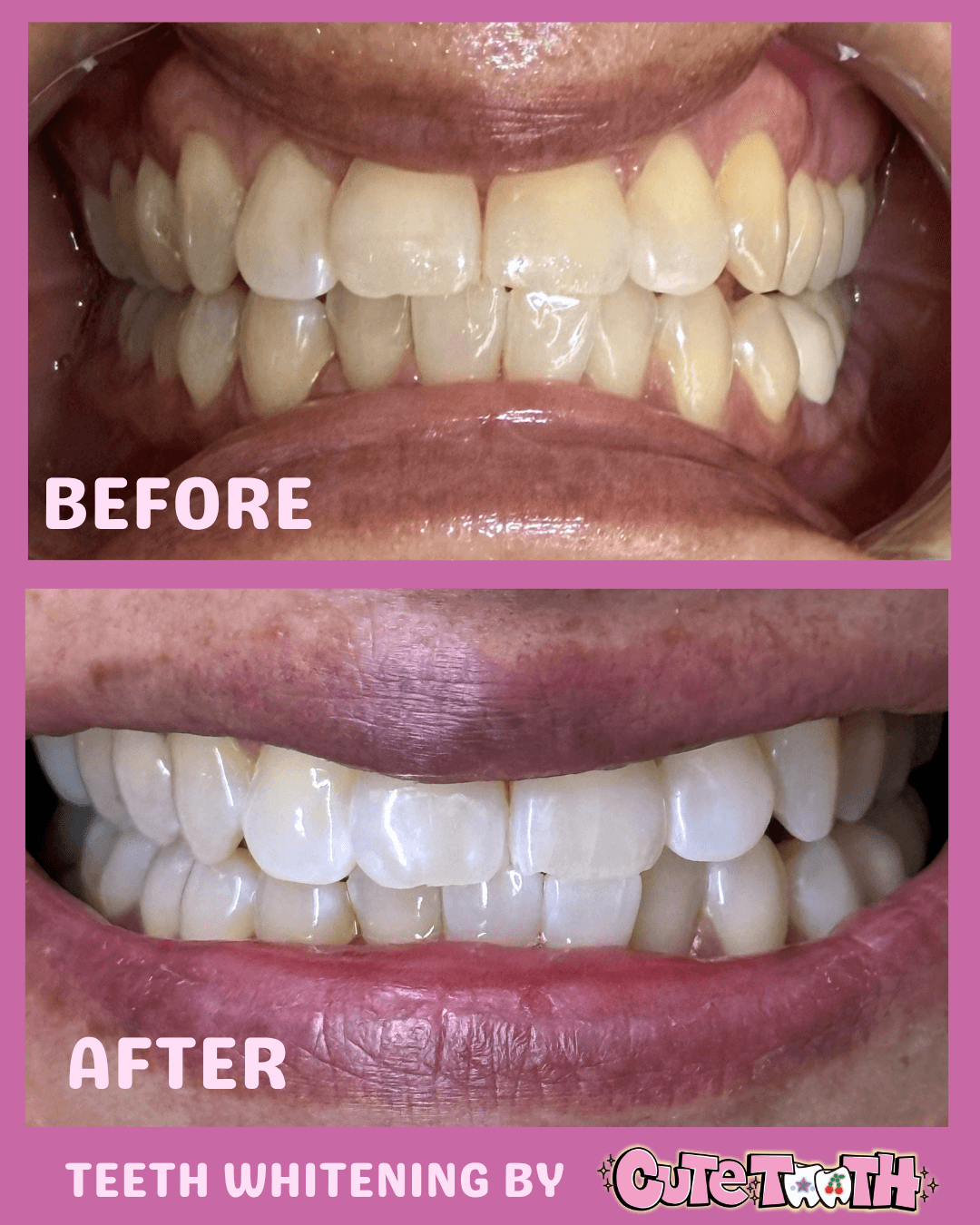 Close-up of person's teeth before and after whitening, showing improved brightness and color in the after image.