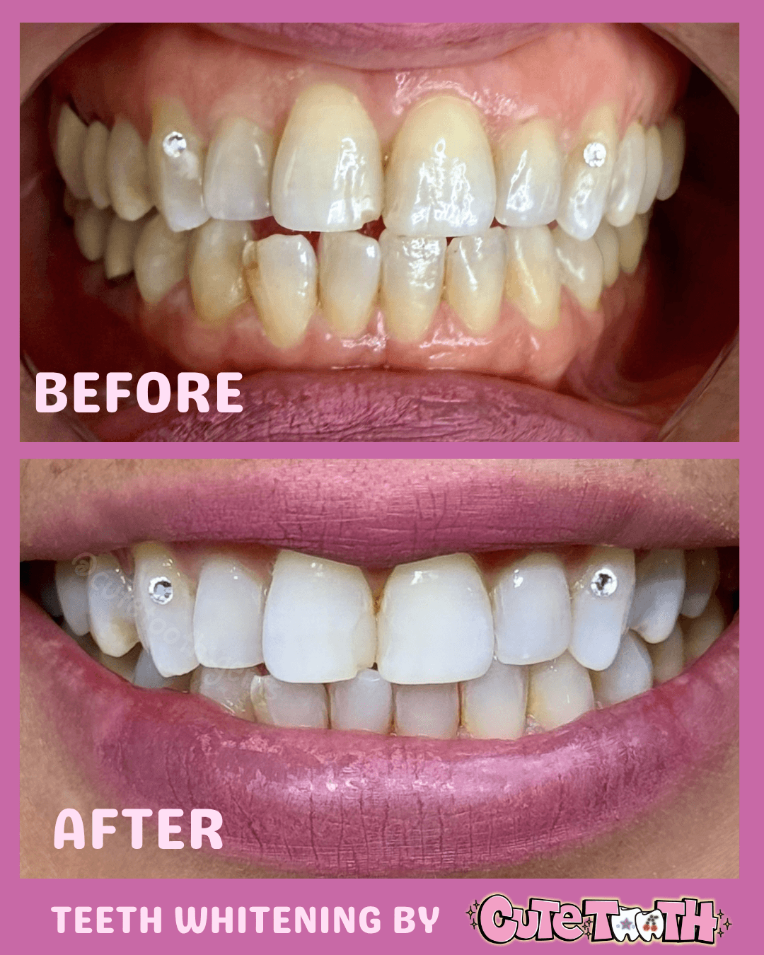 Close-up of teeth before and after whitening, showing improved color and appearance, with pink background and pink border.
