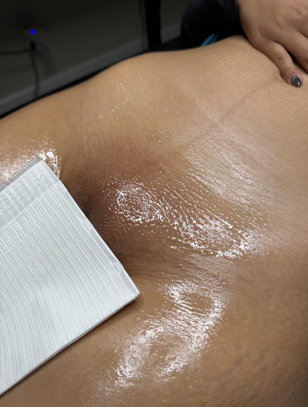 Close-up of a person's chest with a white cloth and shiny skin, possibly in a medical or skincare setting.